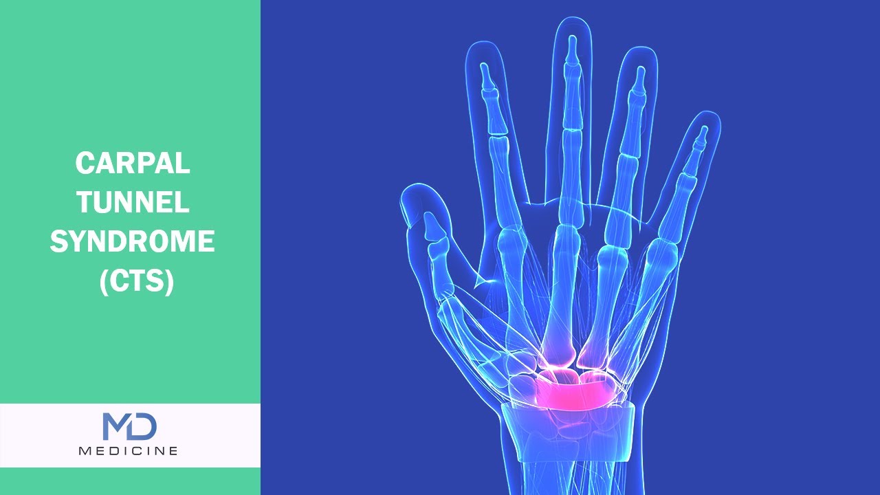 Carpal Tunnel Syndrome (CTS)