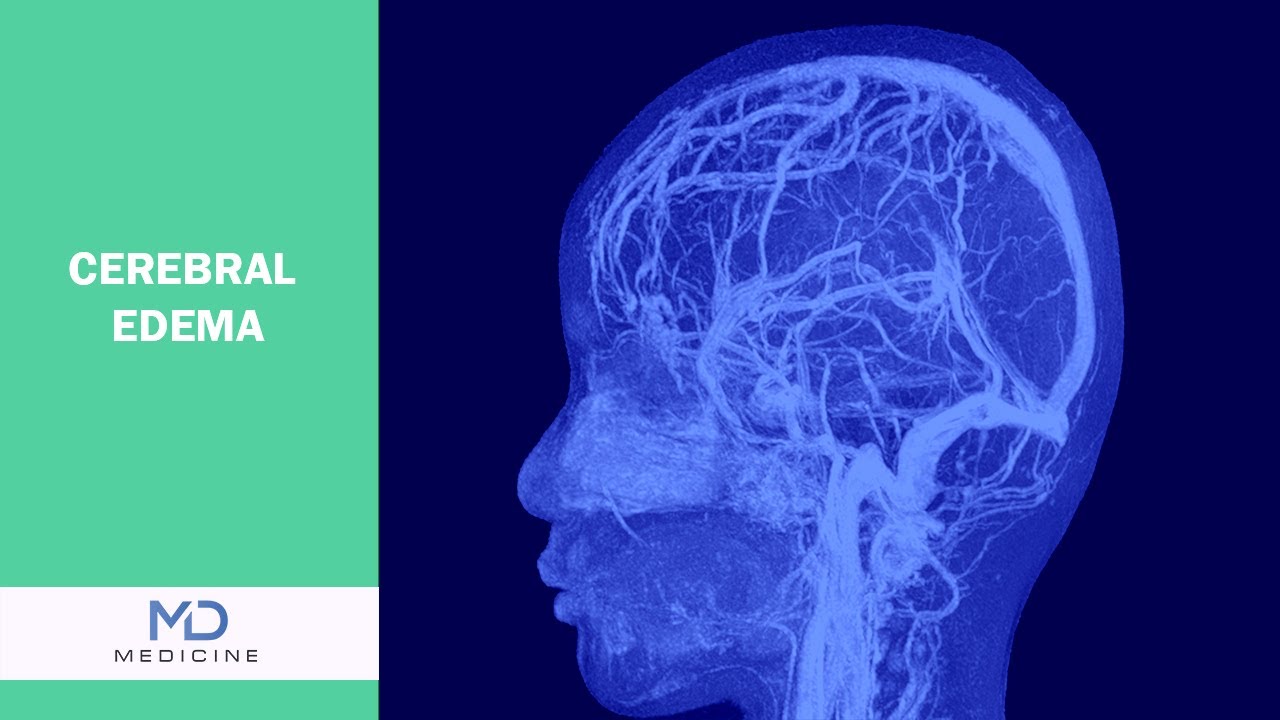 Cerebral Edema