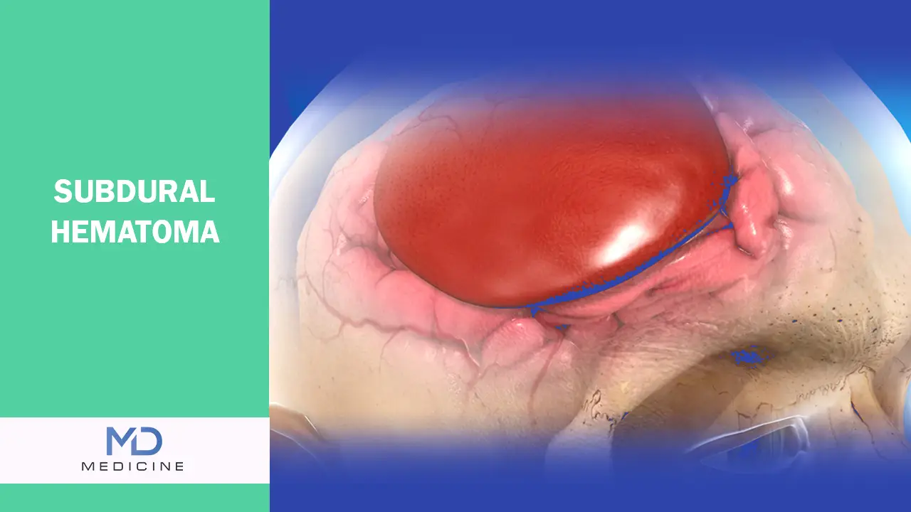 Subdural hematoma