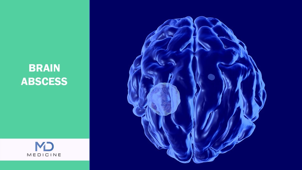 Brain Abscesses