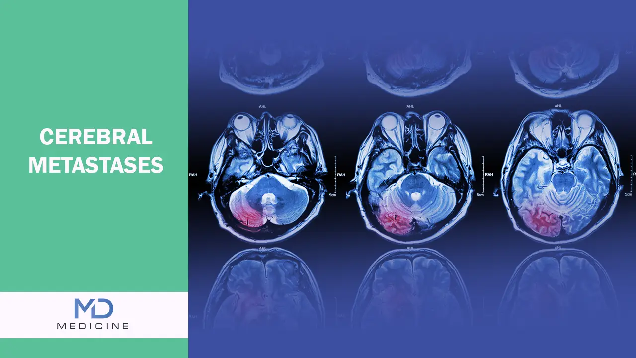 Cerebral Metastases