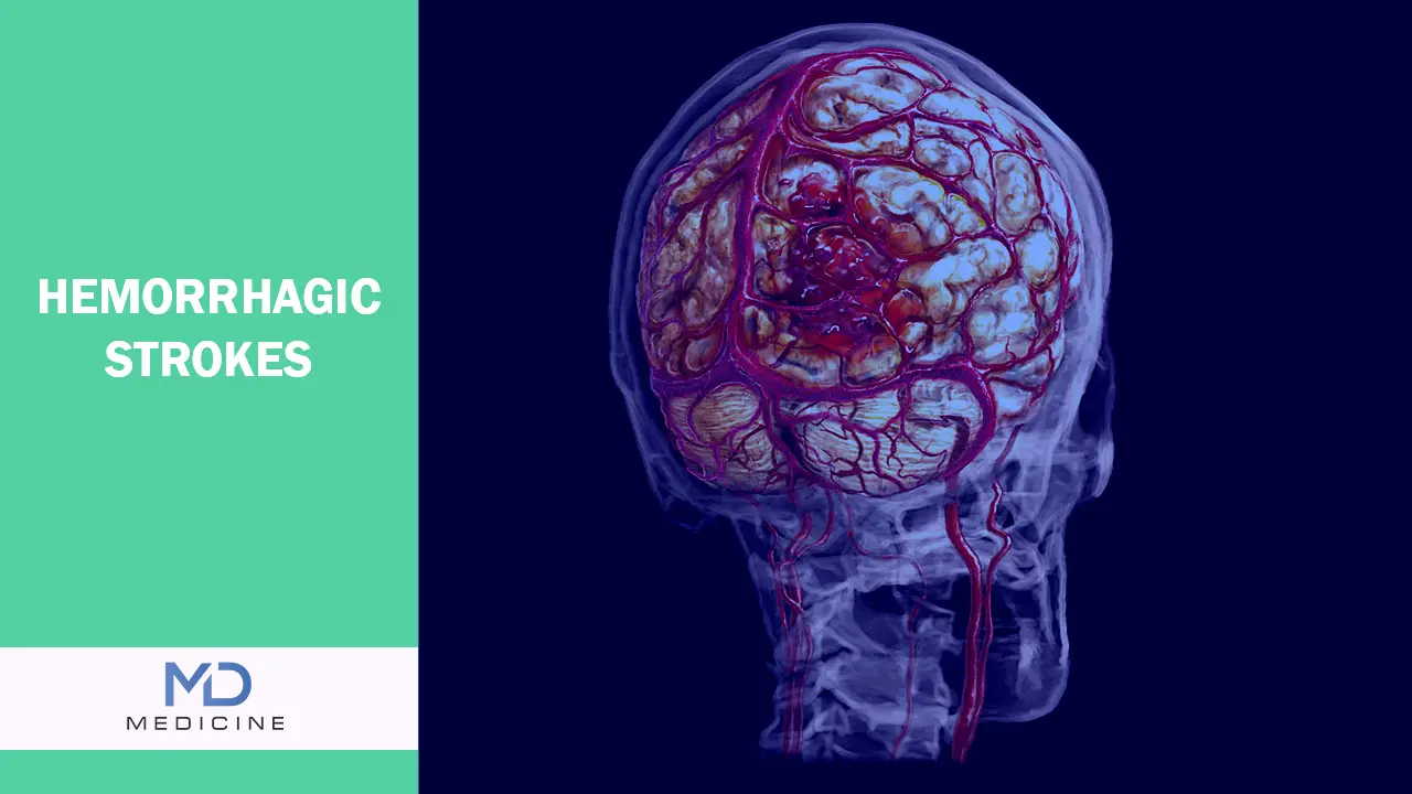 Hemorrhagic Strokes