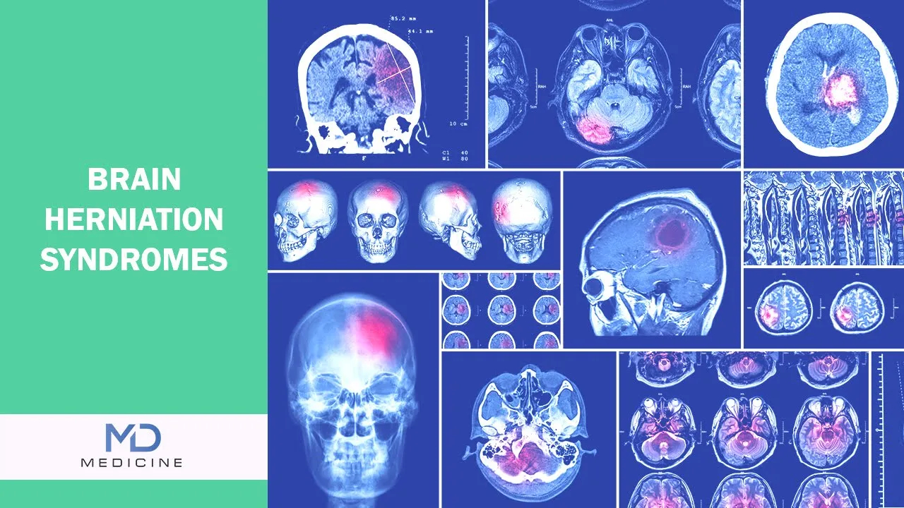 Brain Herniation Syndromes